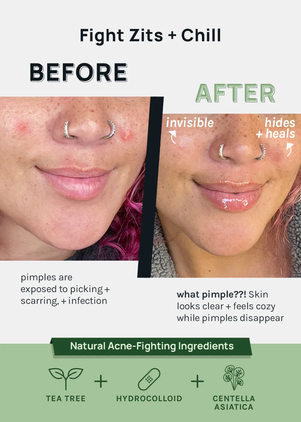 AOA Skin Invisible Acne Patches - 6 Sheets